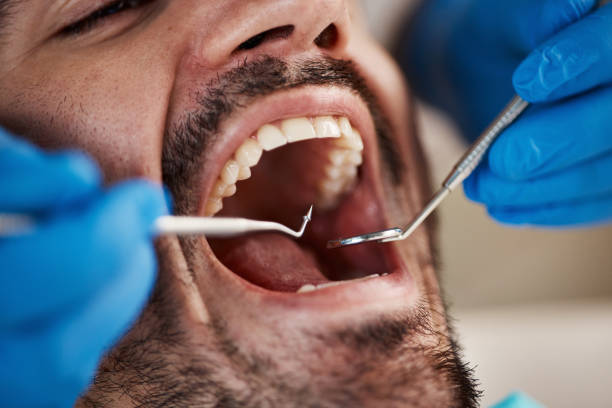 Best Knocked-Out Tooth (Avulsed Tooth) Treatment in Bronson, FL